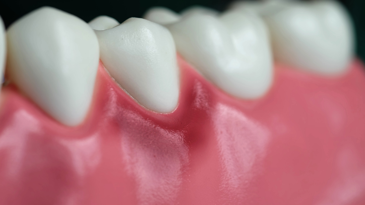 Diş Eti İltihabı ve Periodontitis: Belirtileri, Tedavisi, Korunma Yolları
