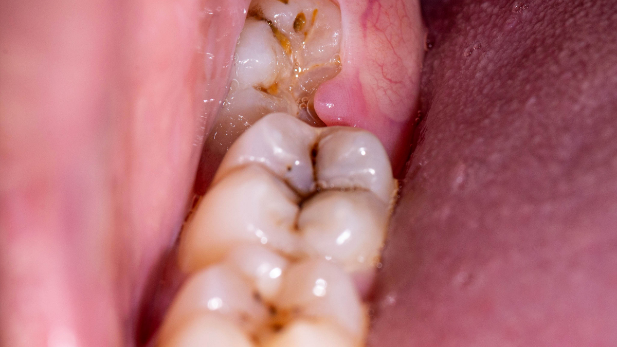 Yirmi Yaş Dişleri Diğer Dişleri Gerçekten Eğriltir Mi?