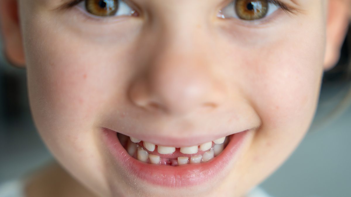 Süt Dişlerinde Meydana Gelen Kırılma ve Travmalarda Acil Müdahale