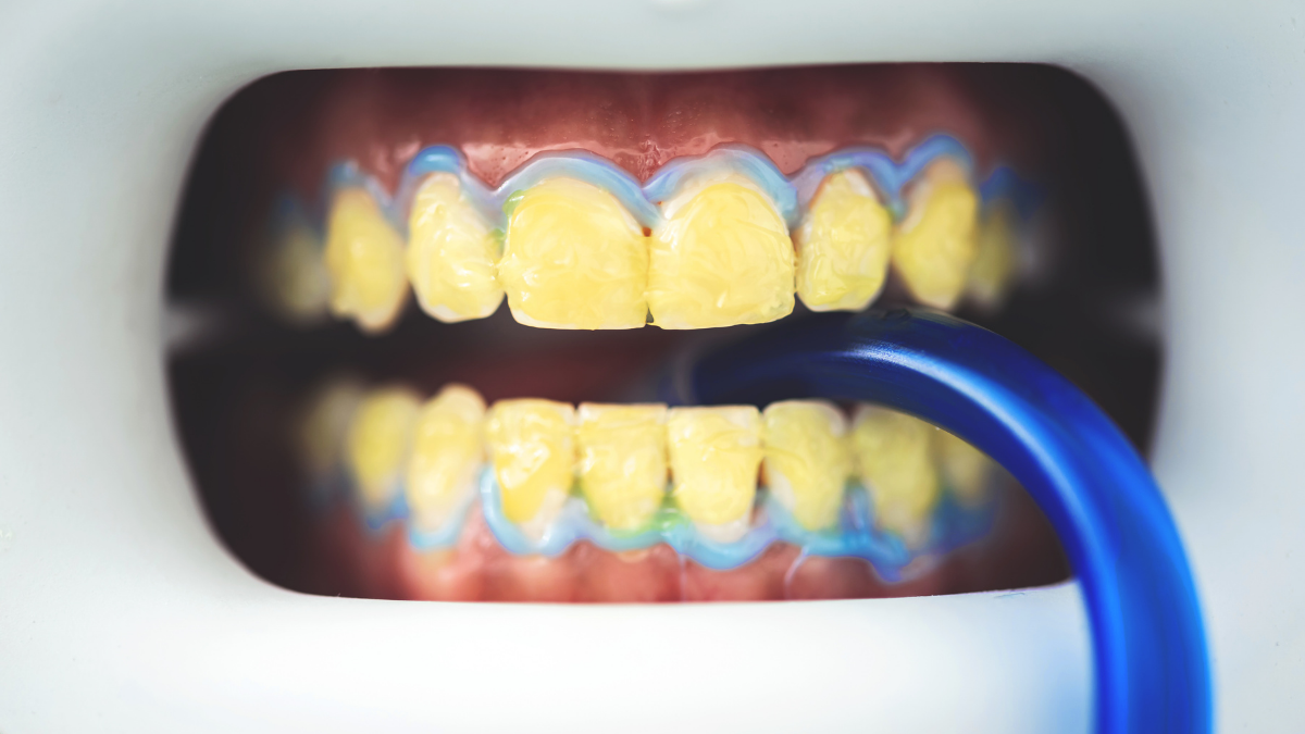 Kahve ve Çay Lekeleriyle Savaşta Profesyonel Diş Temizliğinin Etkisi