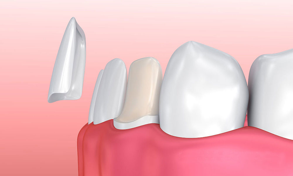 Veneer ne demek