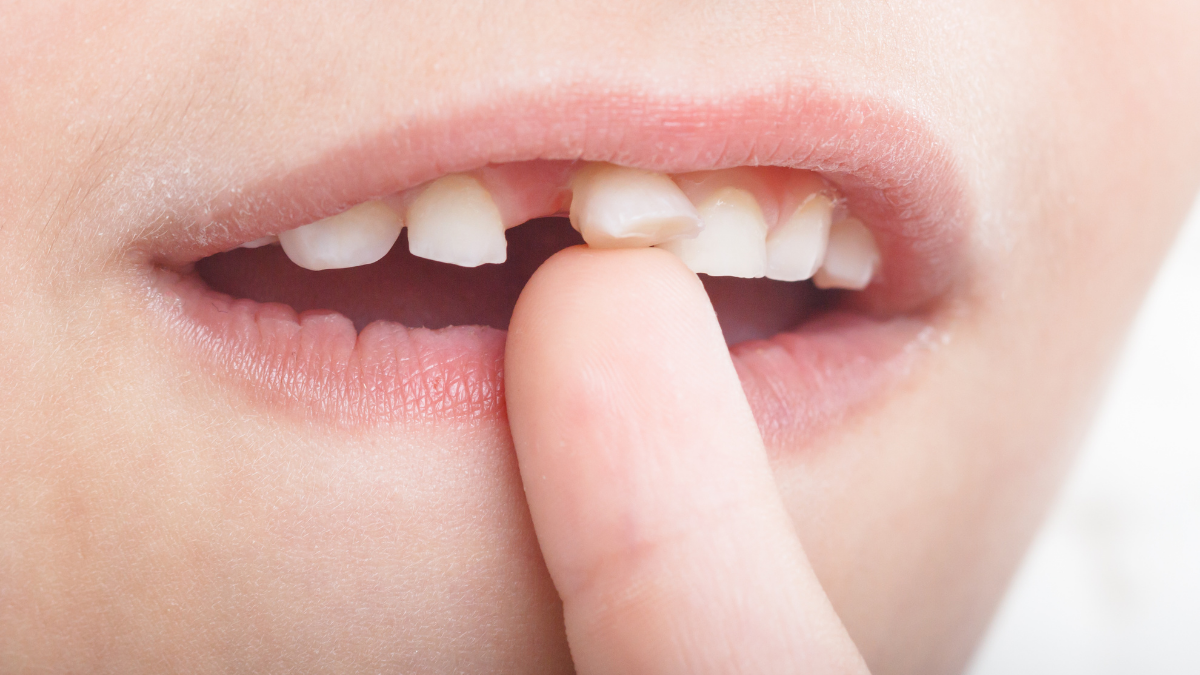 Yerinden Tamamen Çıkan Dişin Kurtarılması İçin Yapılması Gerekenler