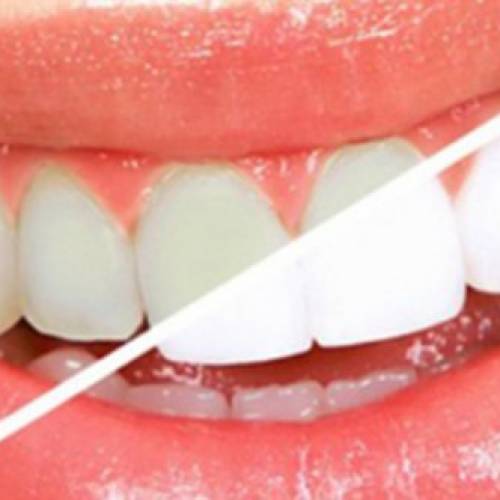Vital / Devital Bleaching