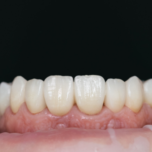 Zirkonyum ve Seramik Materyallerin Diş Hekimliğindeki Biyouyumluluğu