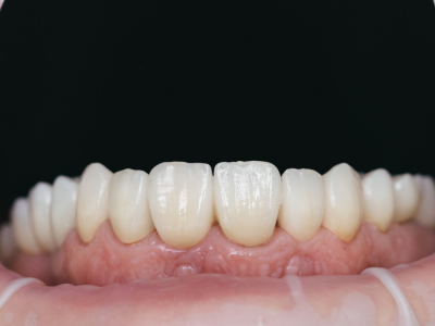 Zirkonyum ve Seramik Materyallerin Diş Hekimliğindeki Biyouyumluluğu