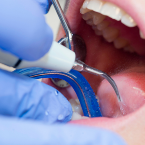 Bademcik Taşları Neden Olur ve Ağız Kokusuyla İlişkisi Nedir?