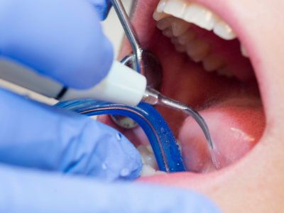 Bademcik Taşları Neden Olur ve Ağız Kokusuyla İlişkisi Nedir?