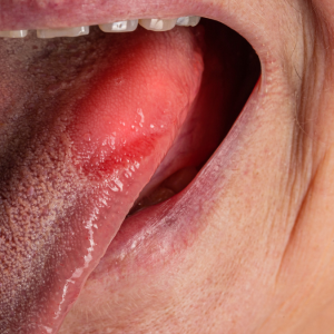 B12 Vitamini ve Demir Eksikliğinin Ağız İçindeki Belirtileri