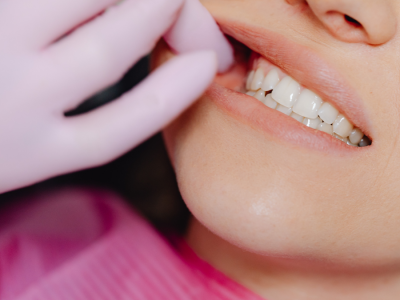 Diyabet Hastalarında Ağız ve Diş Sağlığı Yönetimi