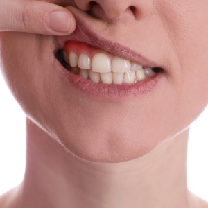 Düzenli Kullanılan İlaçların Diş Etlerine Etkileri