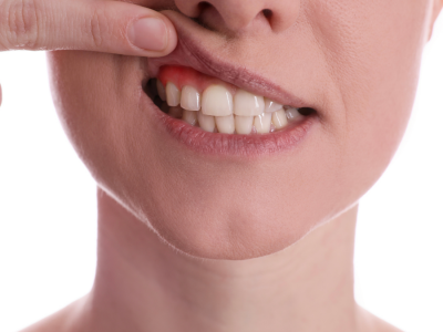 Düzenli Kullanılan İlaçların Diş Etlerine Etkileri