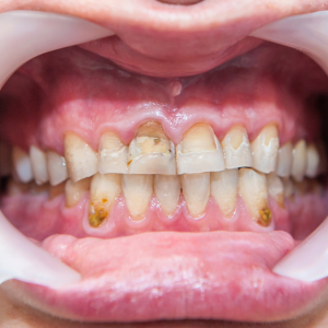 Dişlerdeki Beyaz Nokta Lekeleri ve Tedavi Seçenekleri