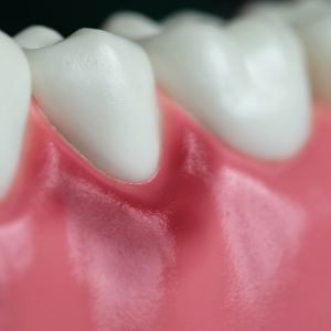 Diş Eti İltihabı ve Periodontitis: Belirtileri, Tedavisi, Korunma Yolları