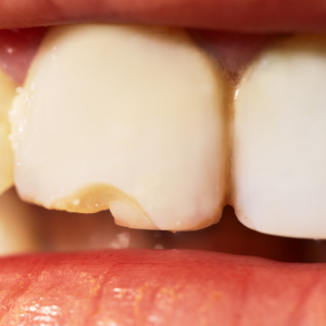 Kırık veya Çatlak Dişlerin Estetik Olarak Onarımı