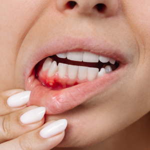 Diş Eti Çekilmesinin Temel Nedenleri ve Periodontal Sağlığı Korumak
