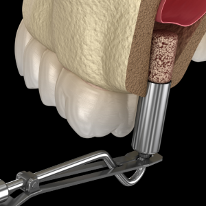 Sinüs Lift Sinüs Yükseltme Operasyonu