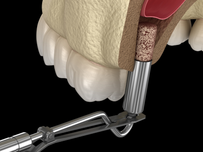 Sinüs Lift Sinüs Yükseltme Operasyonu