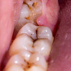 Yirmi Yaş Dişleri Diğer Dişleri Gerçekten Eğriltir Mi?