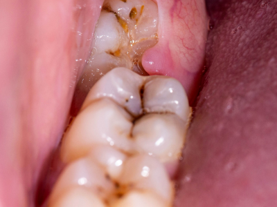 Yirmi Yaş Dişleri Diğer Dişleri Gerçekten Eğriltir Mi?