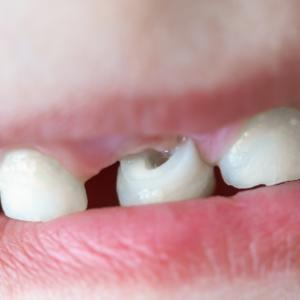 Süt Dişlerinde Görülen Siyah Lekeler ve Tedavi Yöntemleri