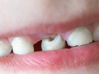 Süt Dişlerinde Görülen Siyah Lekeler ve Tedavi Yöntemleri