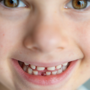 Süt Dişlerinde Meydana Gelen Kırılma ve Travmalarda Acil Müdahale