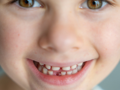 Süt Dişlerinde Meydana Gelen Kırılma ve Travmalarda Acil Müdahale