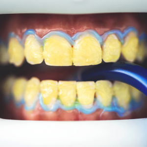 Kahve ve Çay Lekeleriyle Savaşta Profesyonel Diş Temizliğinin Etkisi