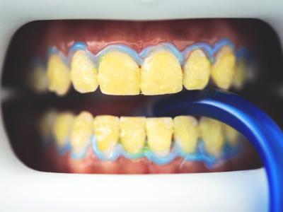 Kahve ve Çay Lekeleriyle Savaşta Profesyonel Diş Temizliğinin Etkisi