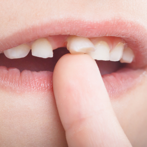 Yerinden Tamamen Çıkan Dişin Kurtarılması İçin Yapılması Gerekenler