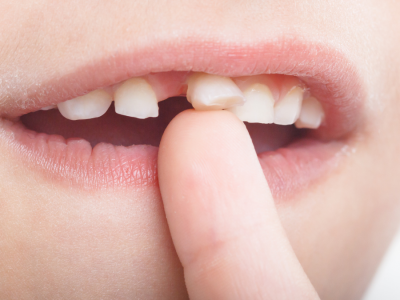 Yerinden Tamamen Çıkan Dişin Kurtarılması İçin Yapılması Gerekenler