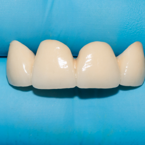 Zirkonyum Kaplamaların Altındaki Dişler Çürür Mü?