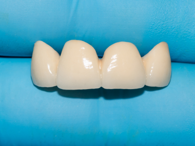 Zirkonyum Kaplamaların Altındaki Dişler Çürür Mü?